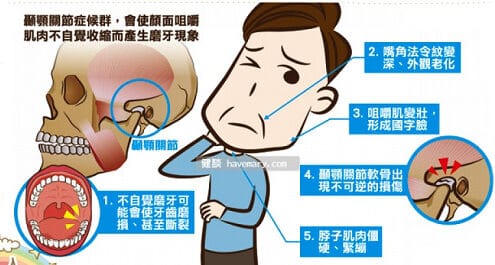 顳顎關節問題