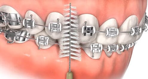牙齒矯正後的日常保養