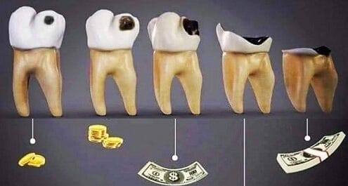 齲齒的早期治療