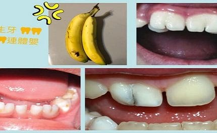 🦷🦷可愛的連體嬰牙🦷🦷