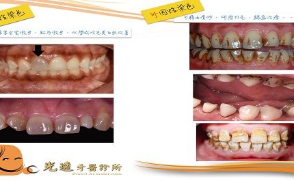 談談”黃板牙”—牙齒變色