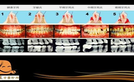 口腔的土石流 🏔🏔🏔—牙周病的形成