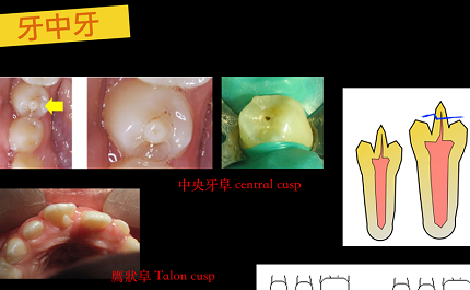 牙中牙 （Dens evaginatus）