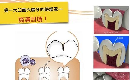 🎯第一大臼齒六歲牙的保護罩—窩溝封填！🎯