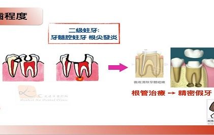 牙牙學院 —『齲齒程度』