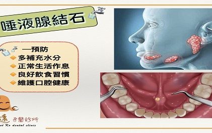 牙牙學院－口腔奇奇怪怪篇 —《唾液腺結石》