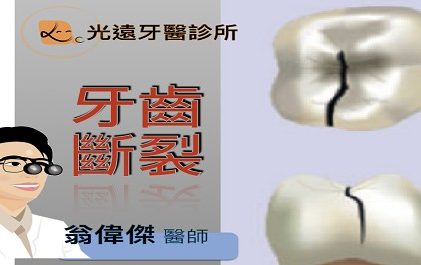 牙牙學院 —『牙齒斷裂』 在日常生活當中，意外總是突然來臨讓人措