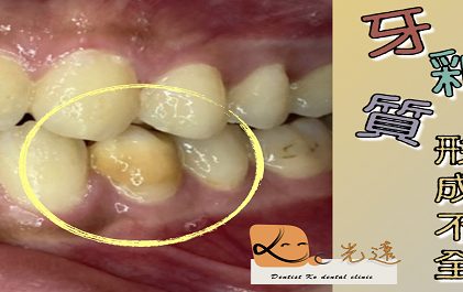 好戲上場之『牙釉質形成不全 〗